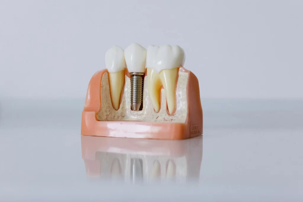 cuanto dura un implante dental
